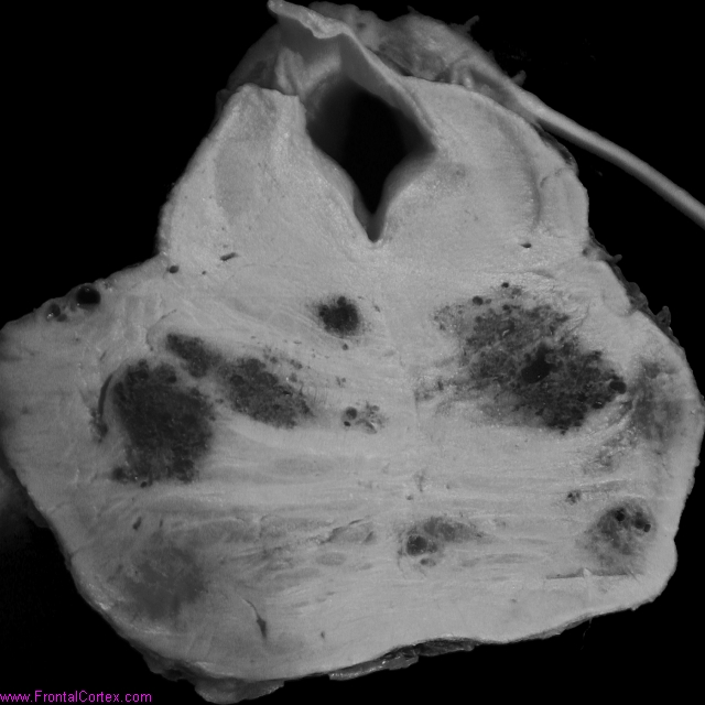 Multiple cavernous  malformations, familial